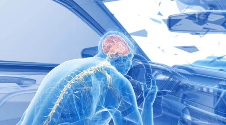 Understanding TBI – Traumatic Brain Injuries From Car Accidents: What You Need to Know